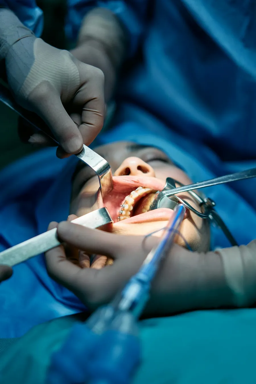 Surgical team performing an All-on-4 dental implant procedure at Taki Dent — a specialist oral surgery team led by Dr. Barış Kıprıtoglu, ITI Fellow